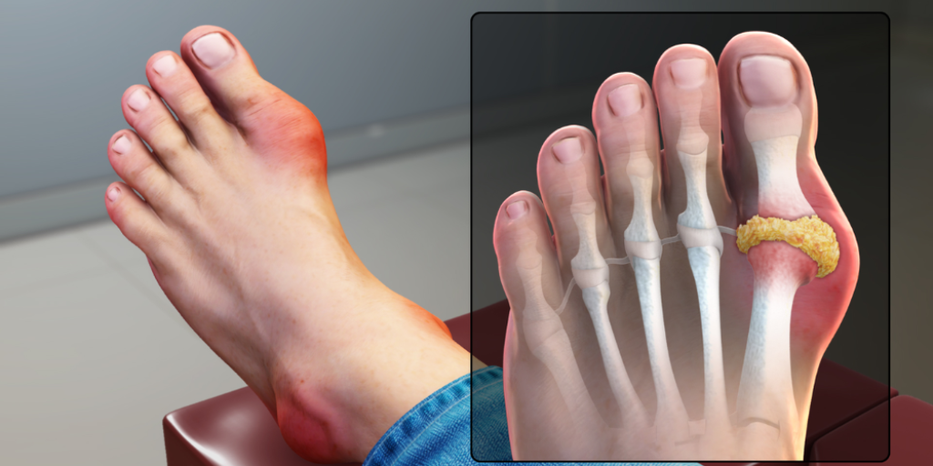 Gout 