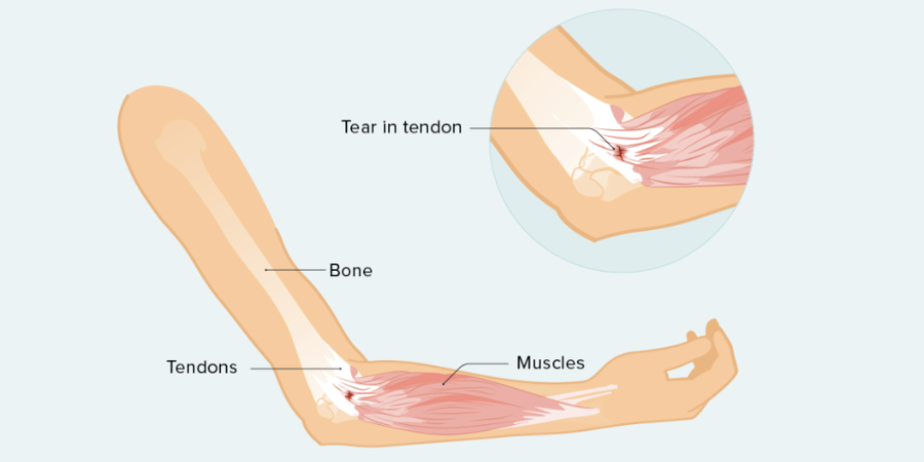 What Is Tendonitis